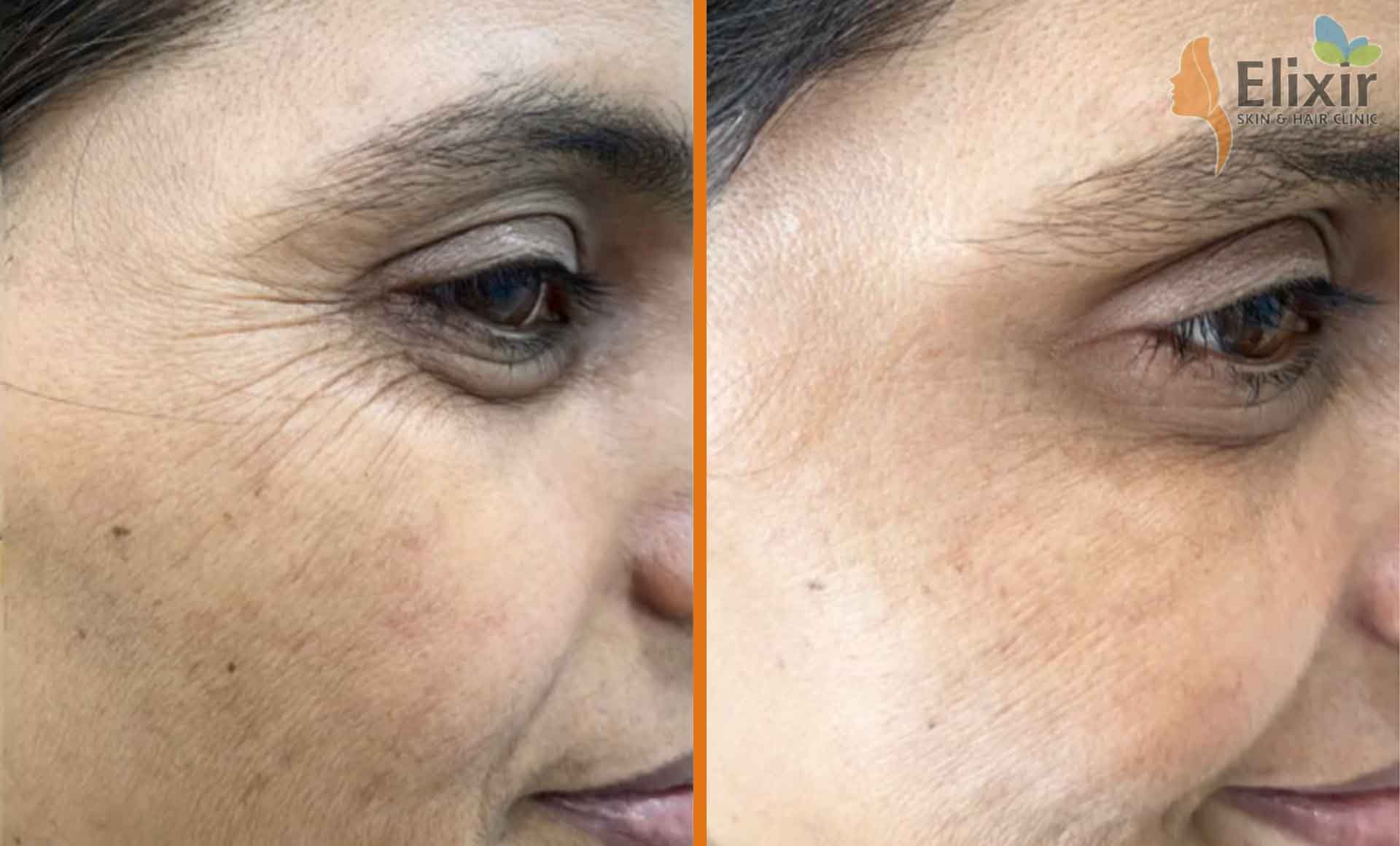 Elixir Anti Aging Botox