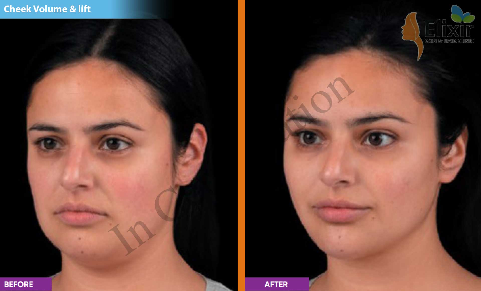 Elixir Anti Aging Dermal Fillers